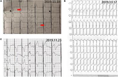 Case Report: Danon Disease: Six Family Members and Literature Review